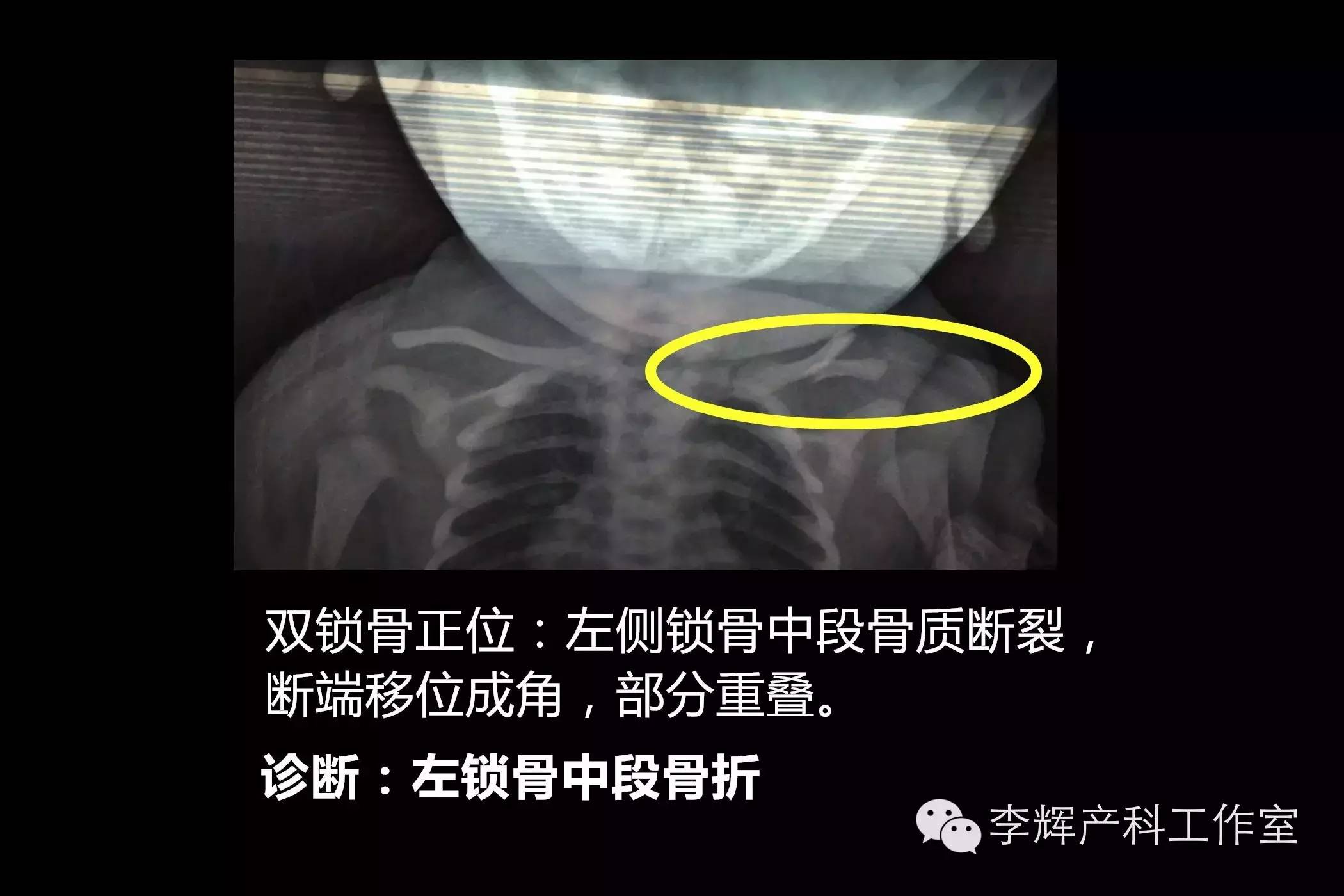 新生儿为什么会锁骨骨折,顺产宝宝锁骨骨折的原因