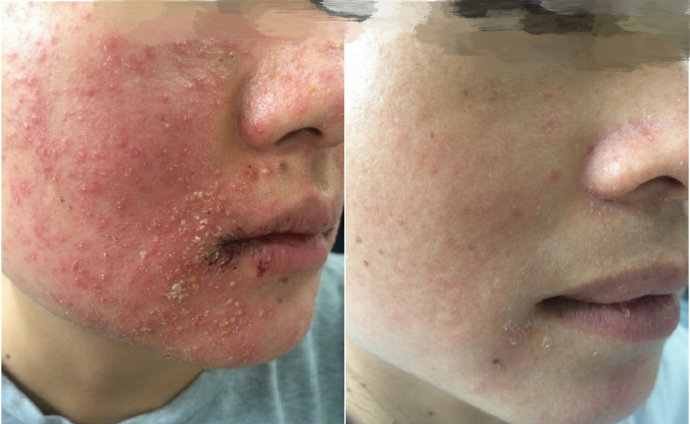 严重激素依赖性皮炎怎么治,治疗激素依赖性皮炎的正确方法