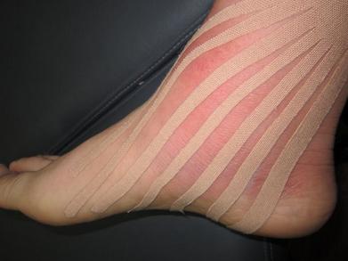 脚踝扭伤韧带拉伤恢复期间会疼吗,膝关节扭伤韧带轻度拉伤如何治疗