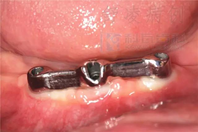 活动假牙戴不住，种植牙又嫌贵该怎么办？