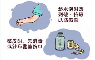 烧伤后如有水泡应及时刺破,被烧伤怎么治疗恢复