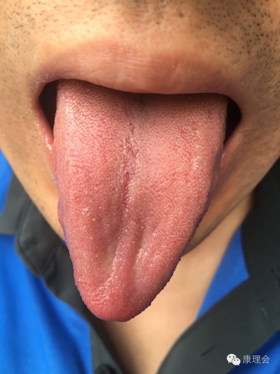 一得这病就是一辈子？！周杰伦张嘉译都中招