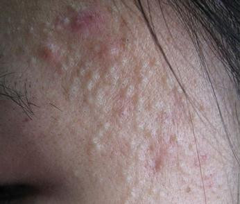 你还敢挤痘痘吗,怎么用简单的方法祛痘痘和消痘