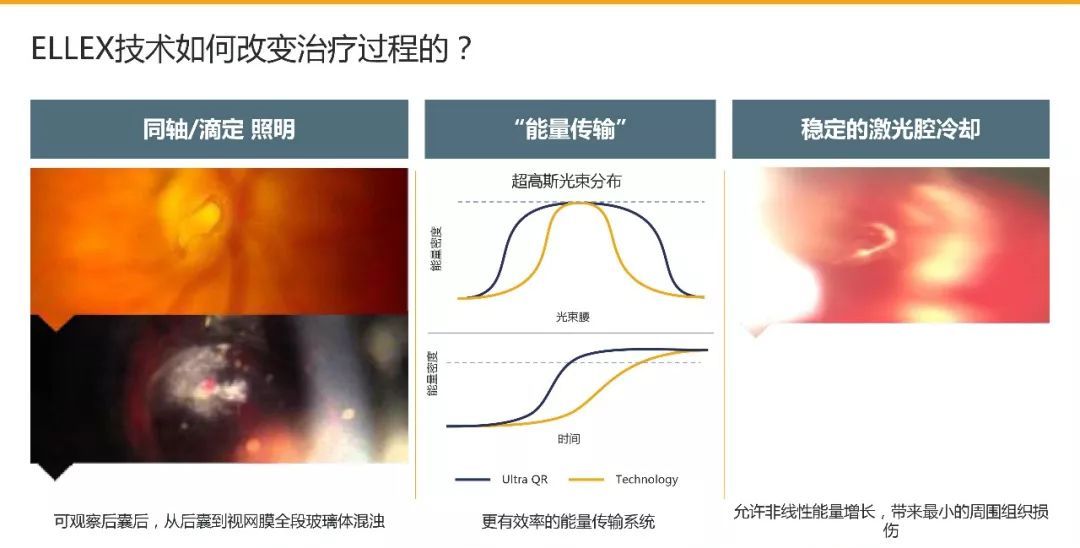 精准安全,无创无忧——UltraQReflex激光玻璃体消融术(LFR)