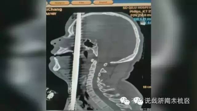 济南男子被1米长钢筋从阴部穿到脑部30名专家开颅开胸开腹手术7小时保住命
