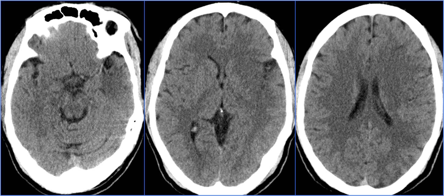 缺血性脑卒中术后管理,急性缺血性脑卒中血管内治疗
