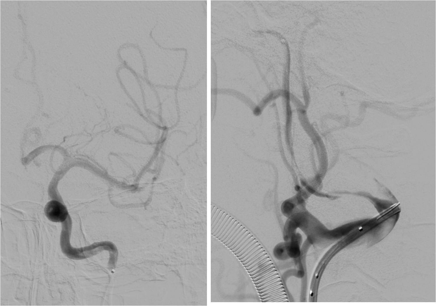 急性缺血性脑卒中血管内治疗,缺血性脑血管病的抗血小板药治疗