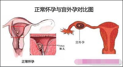 上环后有什么症状和危害,女性上环真对身体不好吗