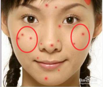 长痘最好的办法就是不要碰它,各种痘对应解决方法