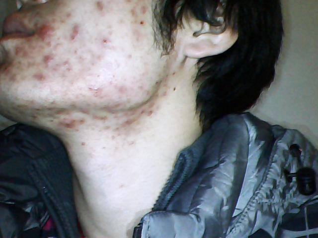 40岁女人下巴长痘痘怎么调理,下巴长痘痘内分泌失调怎么调理