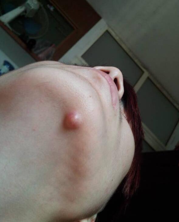 下巴长痘痘怎么调理排毒祛痘,下巴周围长痘痘能吃中药调理吗