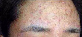 额头下巴长痘痘的原因和解决方法,女孩子额头上长痘痘是什么原因