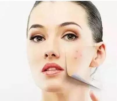 痘痘里面挤出来的白色东西是什么,闭合性粉刺挤出来白色有臭味