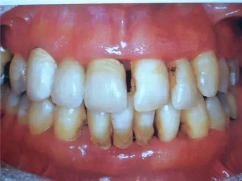 上火导致的牙疼喝茶有用吗,茶能治牙疼吗