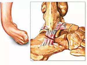 崴脚怎么治才能好得快,崴脚怎么根治