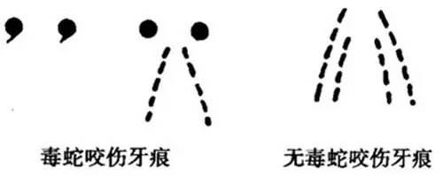 被蛇咬了可以截肢保命吗,救命贴正确方法