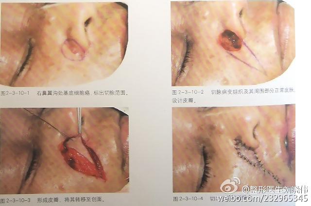 脸上有颗黑痣不去医院才能除掉,脸上黑痣不好去怎么办