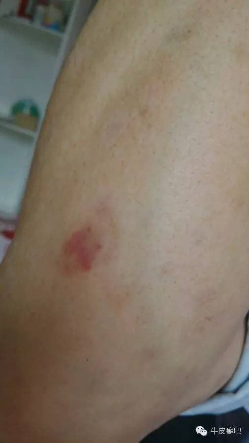 医院专家教你治疗牛皮癣,专家专治牛皮癣方法