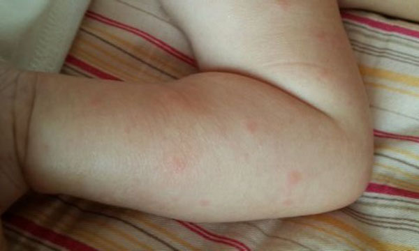 宝宝起了一块红疙瘩是荨麻疹吗,宝宝得了荨麻疹头上为什么有包