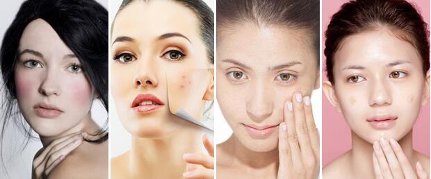 敏感痘痘肌护肤攻略,敏感肌痘痘肌不能用什么成分