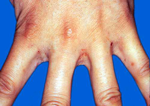 五种树皮治皮肤病,七种树枝熬水治皮肤病是真的吗