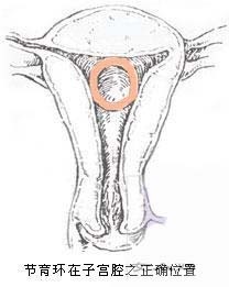 宝妈们安全期,宝妈安环好还是结扎好