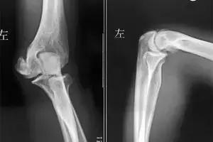 网球肘致肩袖损伤,网球肘是哪个部位损伤