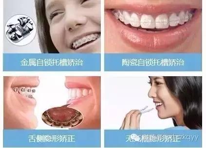 常见排齐牙齿的四大方法,牙齿拥挤重叠矫正过程