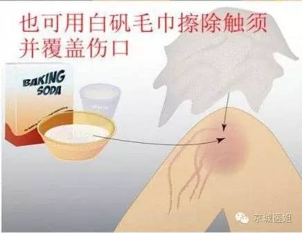 被水母蜇伤的急救方法,海月水母刚买回来怎么急救