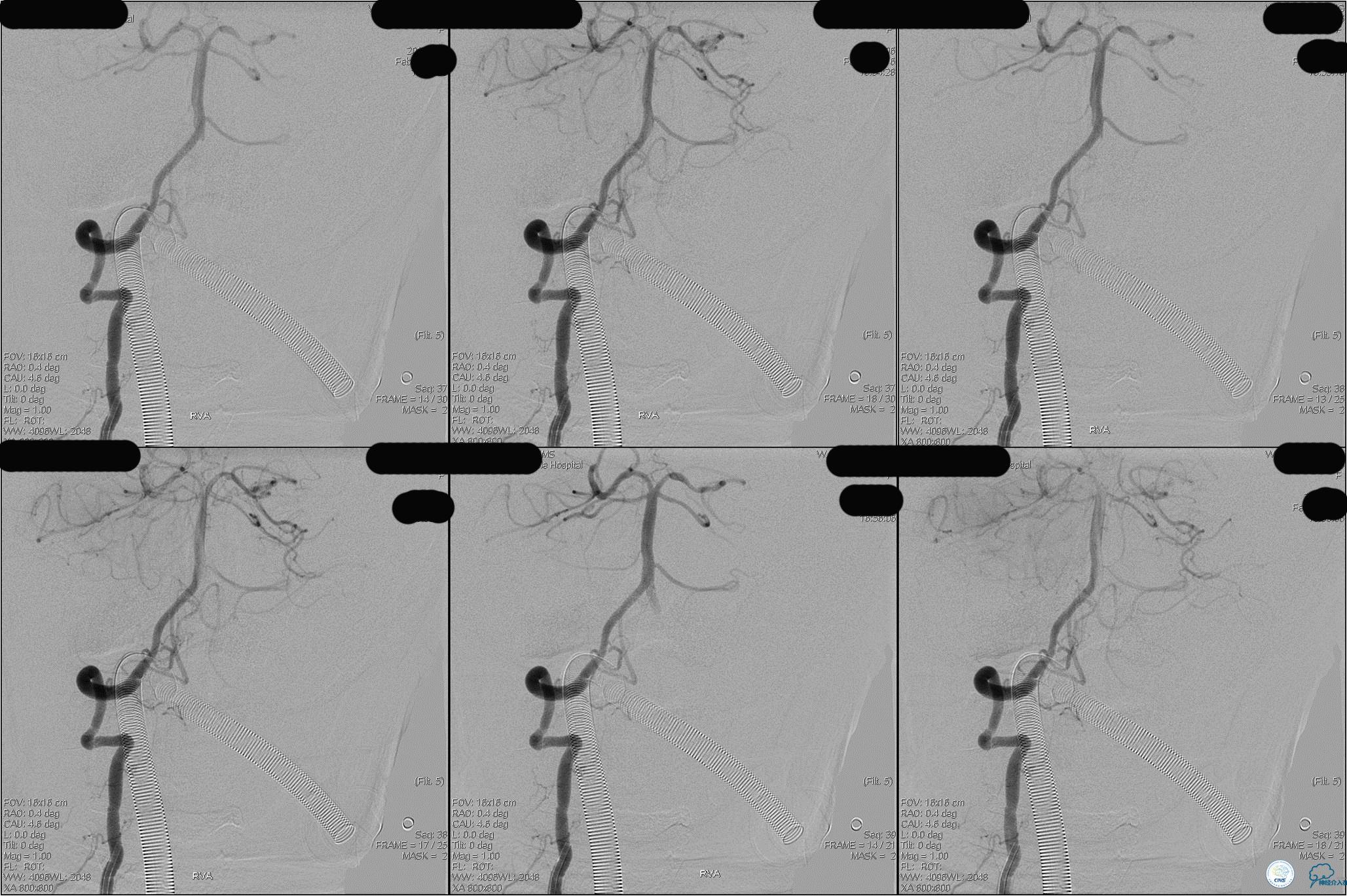 冠状动脉慢性闭塞的介入治疗,颅外段锥动脉狭窄的介入治疗