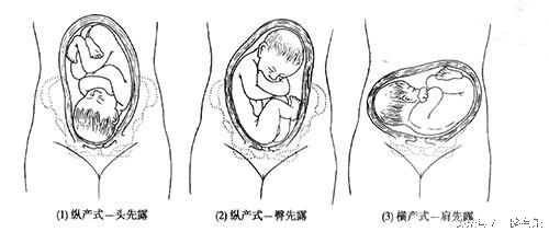 分娩过程中最常见的胎位,分娩中最常见胎位