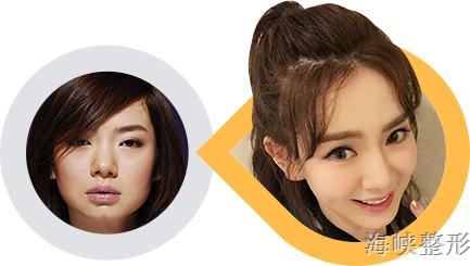 玻尿酸丰唇后恢复原样图片,玻尿酸丰鼻会变宽的对比照