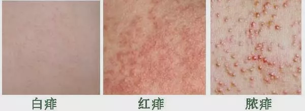 应对痱子的最好方法,痱子有哪几种表现说明得了痱子