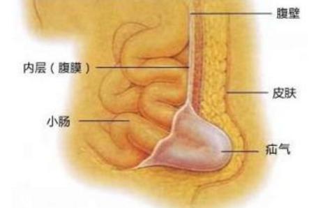 3岁女孩腹股沟有个包块不疼,4岁女孩腹股沟疝有点鼓包