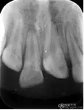 乳牙外伤正确处理方法,幼儿乳牙受到外伤发黑怎么治疗