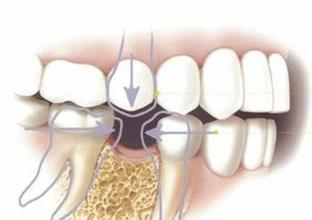 拔牙到底有多惨,拔牙都有什么有趣的经历