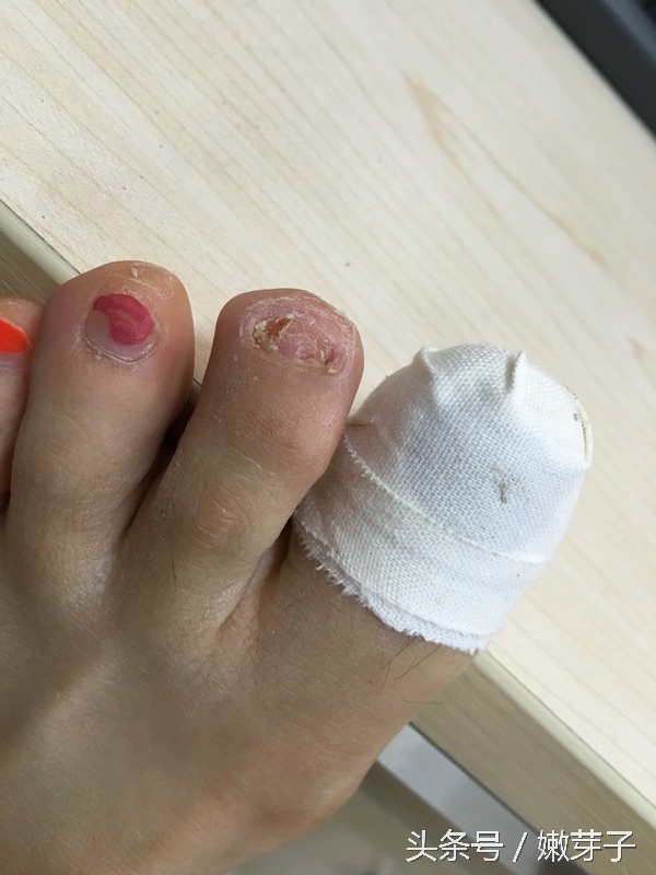 治疗灰指甲过程中需忌口吗,治灰指甲有几个阶段