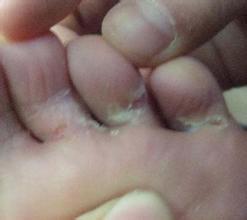 孕妇脚气有什么办法吗,脚气用什么可以掩盖气味