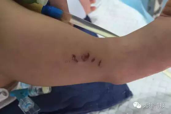 心痛！江阴3个月大男婴嘴部严重烫伤、腿部有牙印、肋骨骨折！这是一个怎样的家啊
