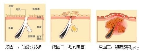 痘痘越来越可怕,记录痘痘生长全过程