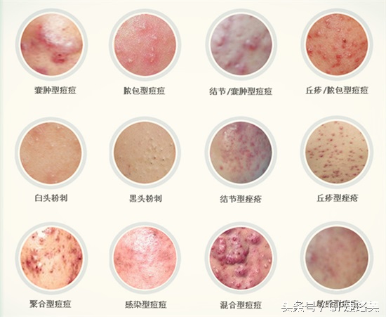 痘痘越来越可怕,记录痘痘生长全过程