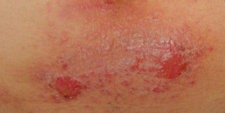 夏天预防湿疹的十种方法,夏季身上爱起湿疹是什么原因