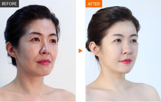 法令纹玻尿酸填充多久能洗脸化妆,法令纹填充玻尿酸会越填越深吗