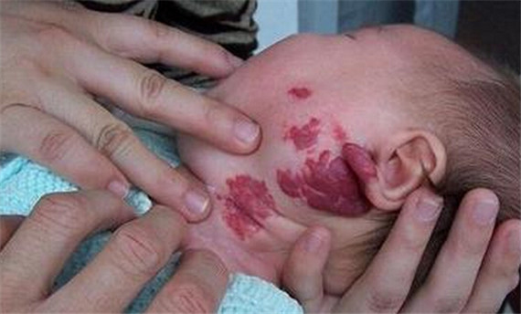 如何正确认识血管瘤,新生儿血管瘤怎么预防