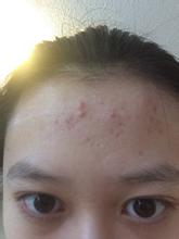 额头全是小米粒的痘痘怎么去掉,额头上有很多痘痘怎么办