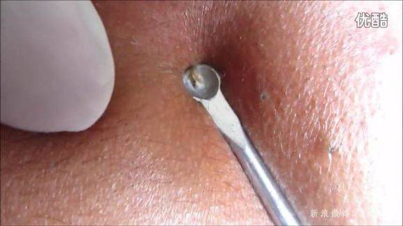 第一次刷酸去黑头新手教程,黑头处理工具用法