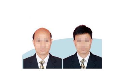 宝宝斑秃抹姜管用吗,治疗斑秃用老姜还是嫩姜