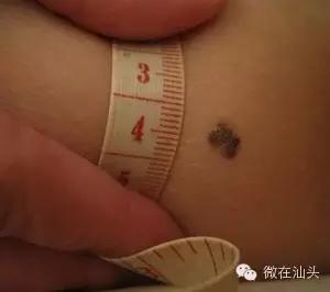 点痣会引发痣癌变吗,痣旁边长了小痣是不是癌变