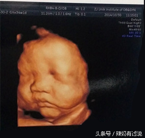 30周4还能做引产吗,34周引产的亲身经历