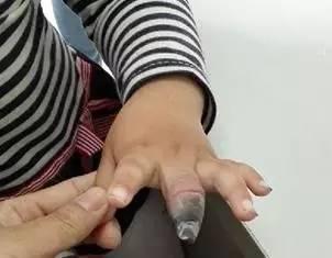 切莫乱用创可贴的危害,创可贴应该怎么贴才正确